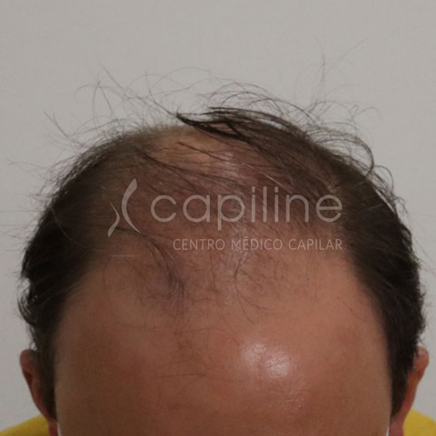 ANTES