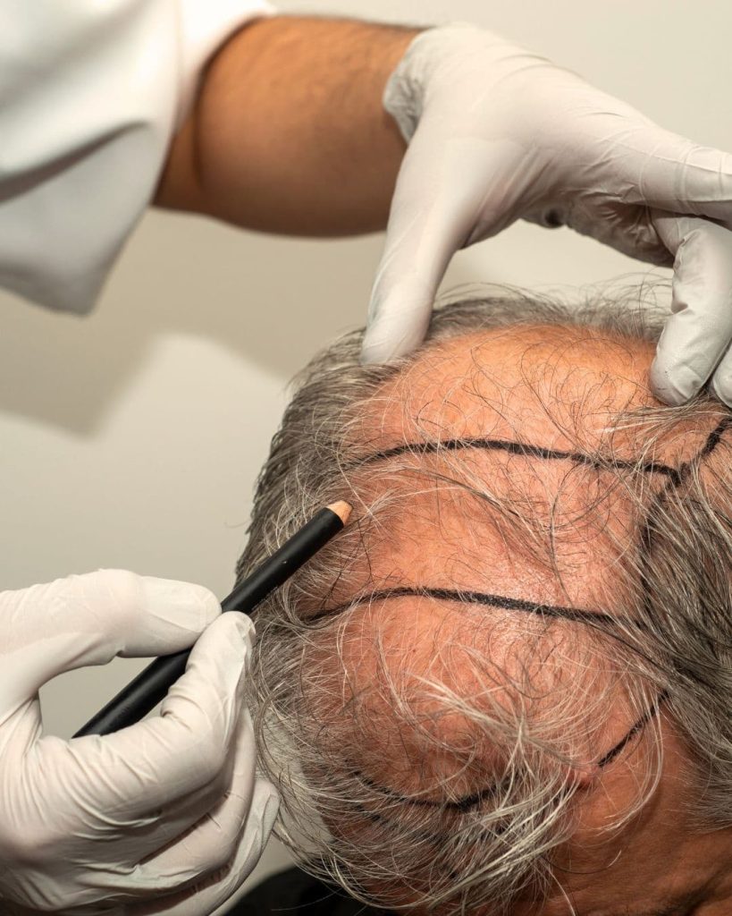 Injerto-Capilar-1500-2500-Folículos